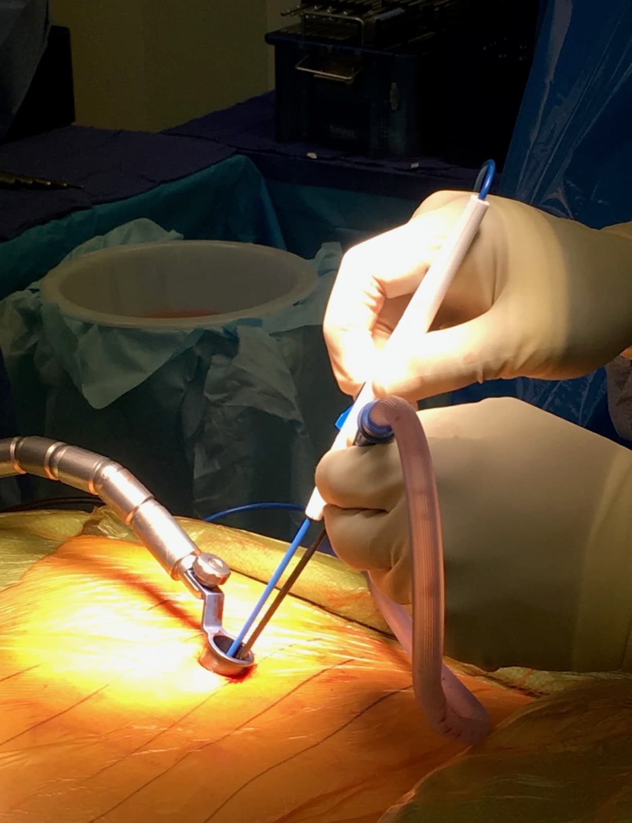 Un cirujano con guantes trabajando a través de un retractor tubular colocado en una incisión pequeña en la espalda del paciente, bajo la lámpara del quirófano. El paciente está completamente cubierto y no se ve ninguna parte de él.
